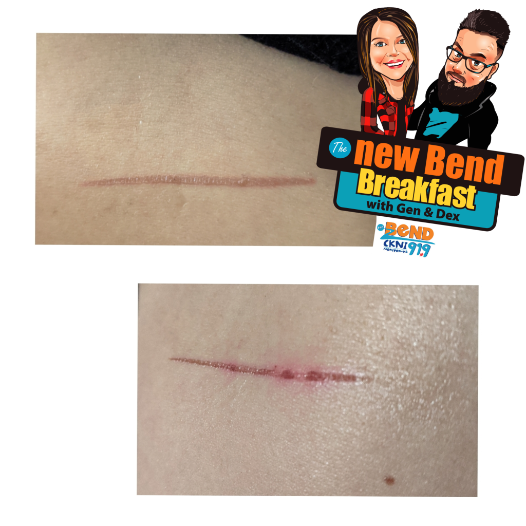 Have you ever accidently burnt yourself? Tell us how 91.9 The Bend